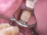 http://www.dentalhealth.org/../uploads/images/fillone.jpg