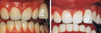 Tooth whitening